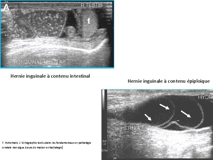 Hernie inguinale à contenu intestinal T. Pettemans. L’ échographie testiculaire: les fondamentaux en pathologie