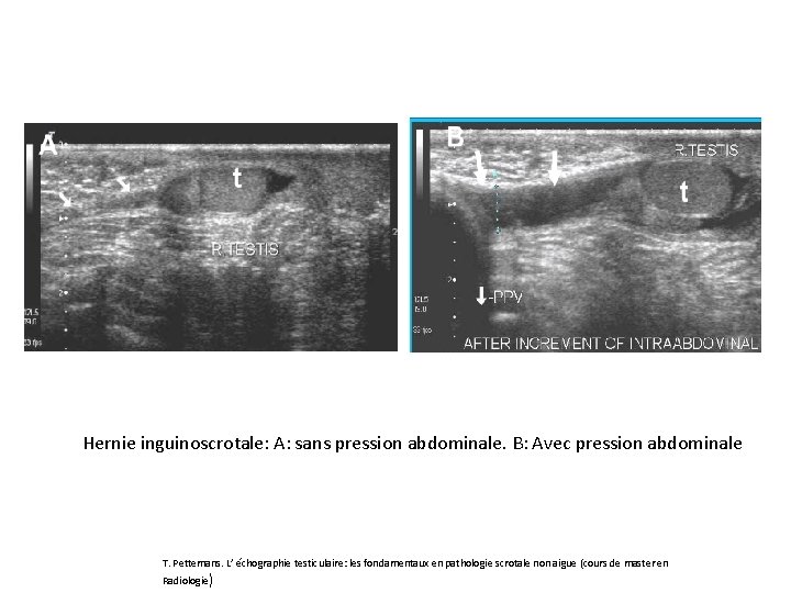 Hernie inguinoscrotale: A: sans pression abdominale. B: Avec pression abdominale T. Pettemans. L’ échographie