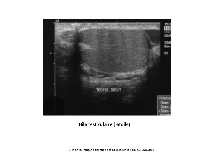 Hile testiculaire ( étoile) B. Martin. Imagerie normale des bourses chez l’adulte. EMC 2003
