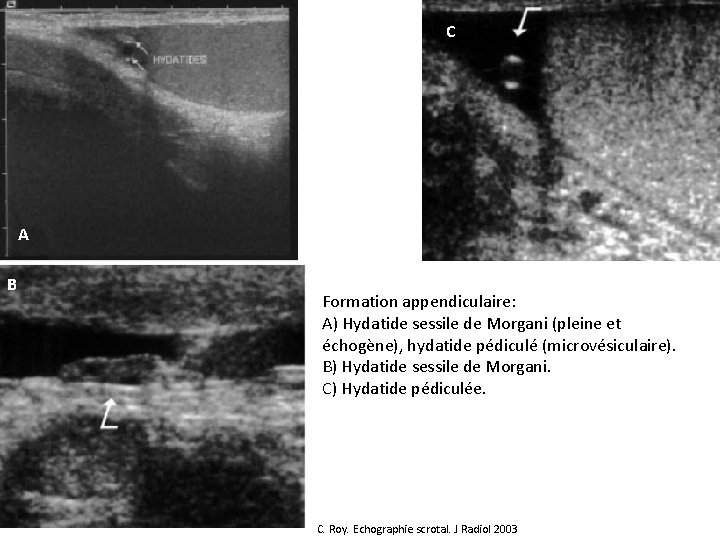 C A B Formation appendiculaire: A) Hydatide sessile de Morgani (pleine et échogène), hydatide