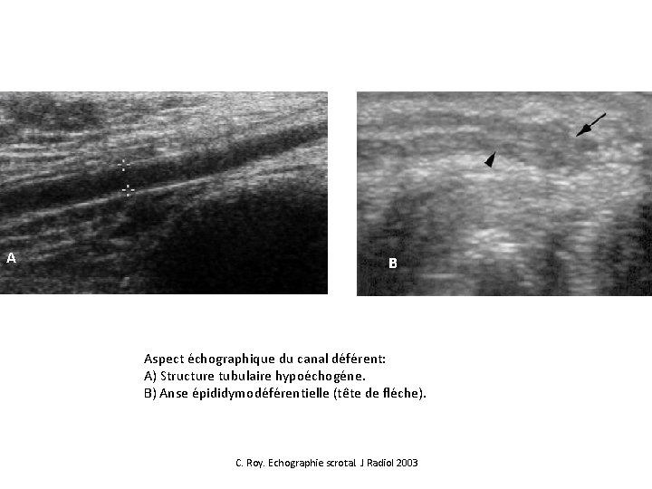 A A B B Aspect échographique du canal déférent: A) Structure tubulaire hypoéchogéne. B)