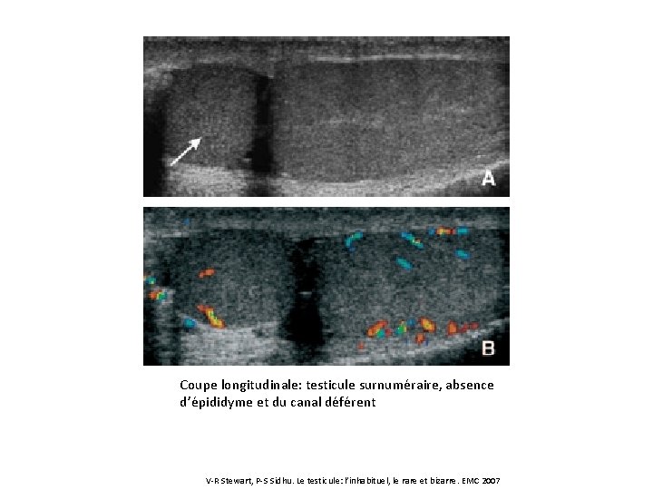 Coupe longitudinale: testicule surnuméraire, absence d’épididyme et du canal déférent V-R Stewart, P-S Sidhu.