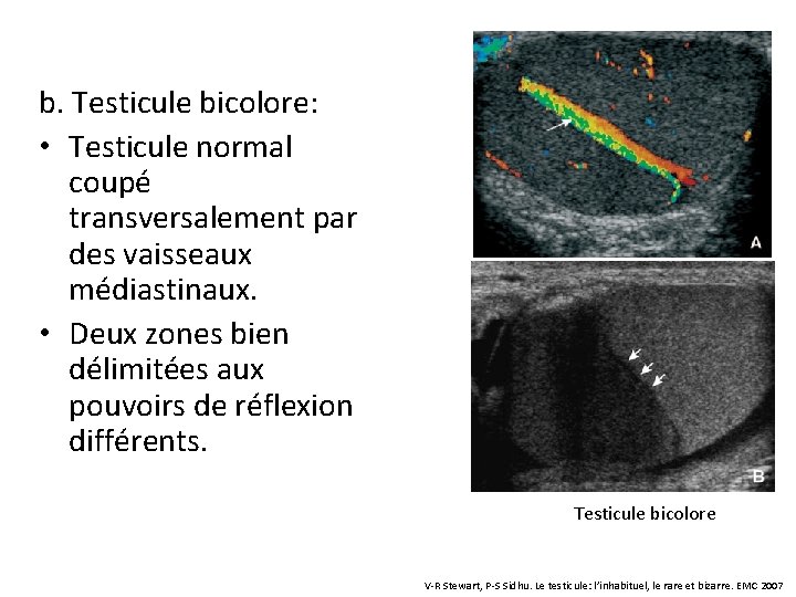 b. Testicule bicolore: • Testicule normal coupé transversalement par des vaisseaux médiastinaux. • Deux