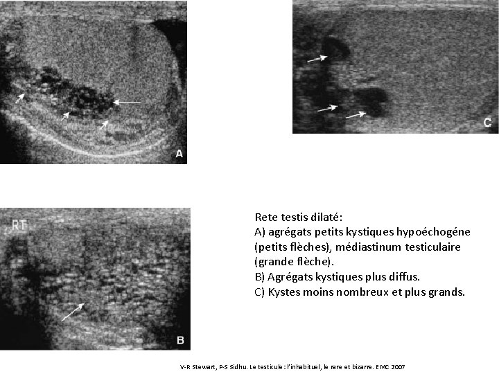 Rete testis dilaté: A) agrégats petits kystiques hypoéchogéne (petits flèches), médiastinum testiculaire (grande flèche).