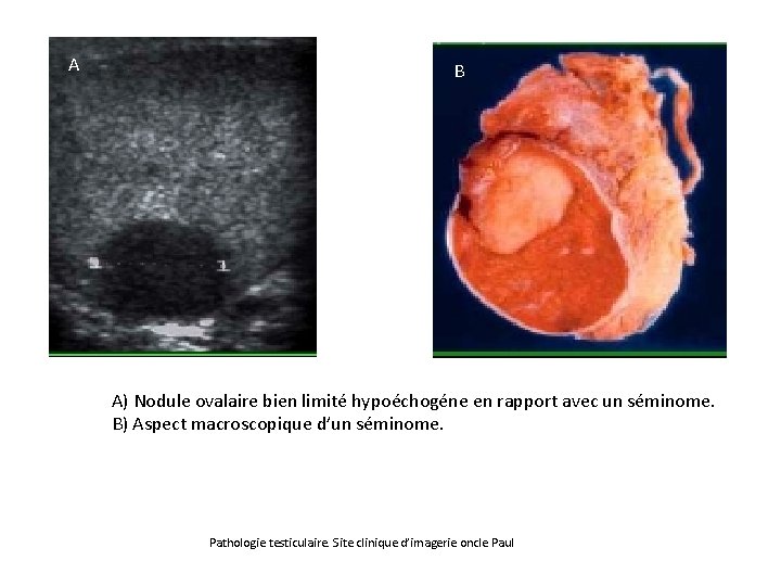 A B A) Nodule ovalaire bien limité hypoéchogéne en rapport avec un séminome. B)