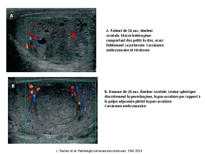 A A. Patient de 16 ans, douleur scrotale. Masse hétérogène comportant des petits kystes,