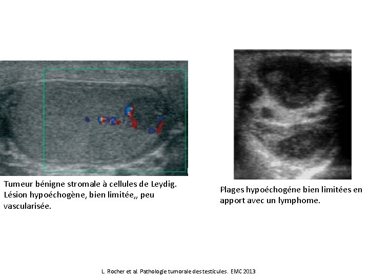 Tumeur bénigne stromale à cellules de Leydig. Lésion hypoéchogène, bien limitée, , peu vascularisée.