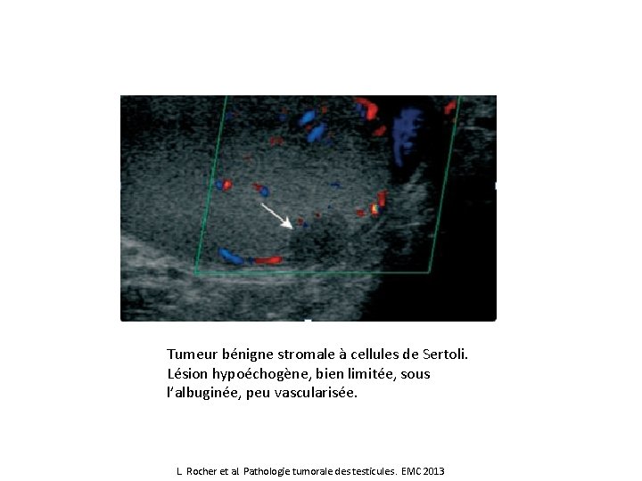 Tumeur bénigne stromale à cellules de Sertoli. Lésion hypoéchogène, bien limitée, sous l’albuginée, peu