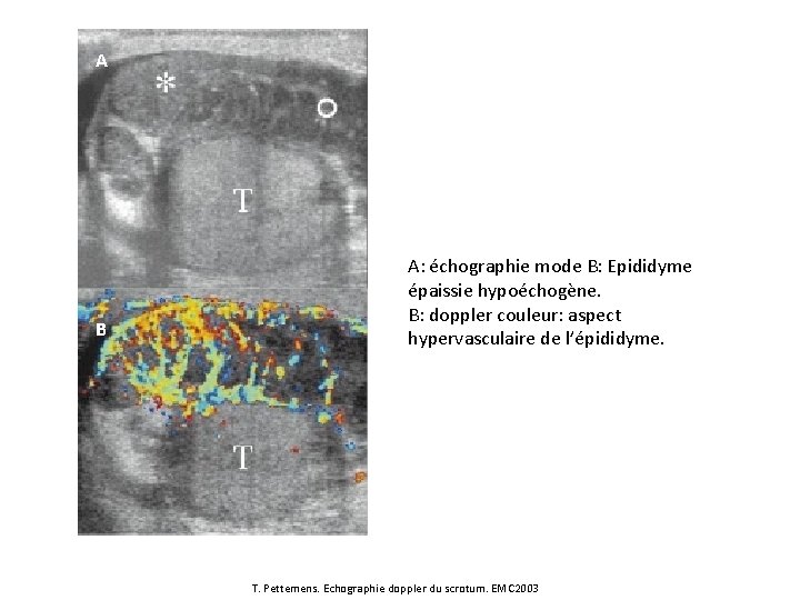 A B A: échographie mode B: Epididyme épaissie hypoéchogène. B: doppler couleur: aspect hypervasculaire