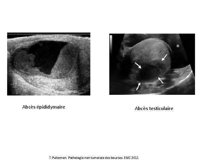 Abcès épididymaire Abcès testiculaire T. Puttemen. Pathologie non tumorale des bourses. EMC 2011 