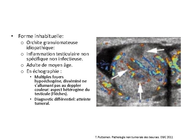  • Forme inhabituelle: o Orchite granulomateuse idiopathique: o Inflammation testiculaire non spécifique non