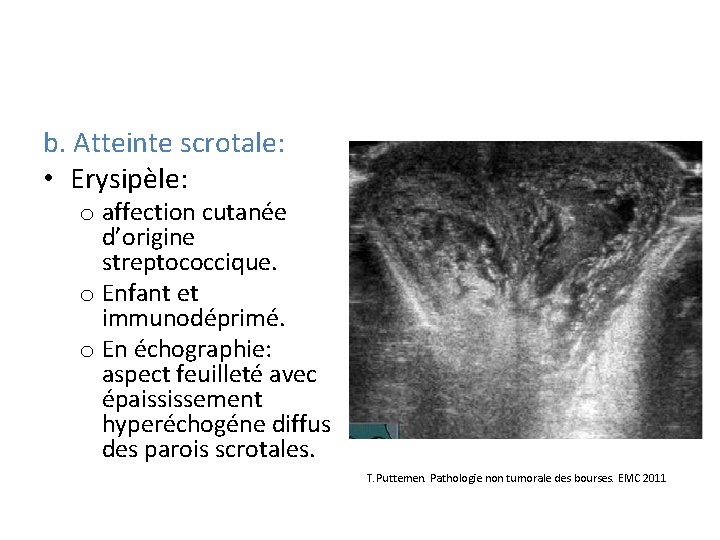 b. Atteinte scrotale: • Erysipèle: o affection cutanée d’origine streptococcique. o Enfant et immunodéprimé.