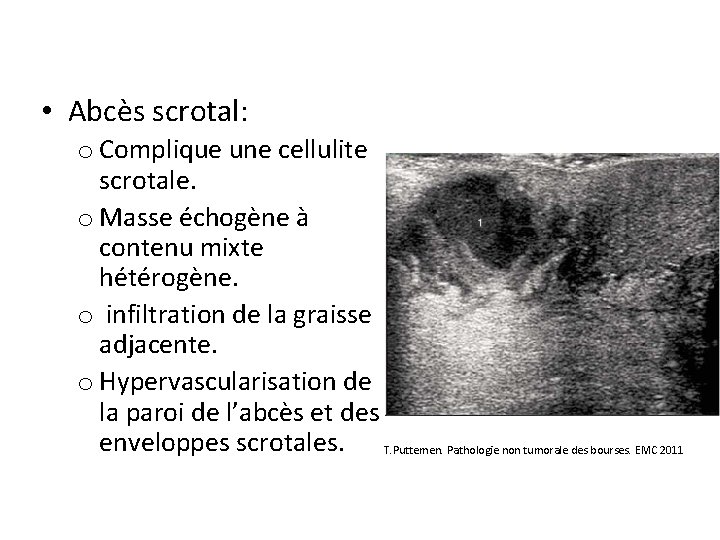  • Abcès scrotal: o Complique une cellulite scrotale. o Masse échogène à contenu
