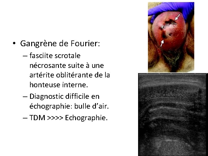  • Gangrène de Fourier: – fasciite scrotale nécrosante suite à une artérite oblitérante