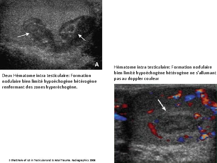 Deux Hématome intra testiculaire: Formation nodulaire bien limité hypoéchogéne hétérogène renfermant des zones hyperéchogéne.