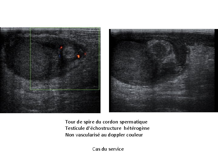 Tour de spire du cordon spermatique Testicule d’échostructure hétérogène Non vascularisé au doppler couleur