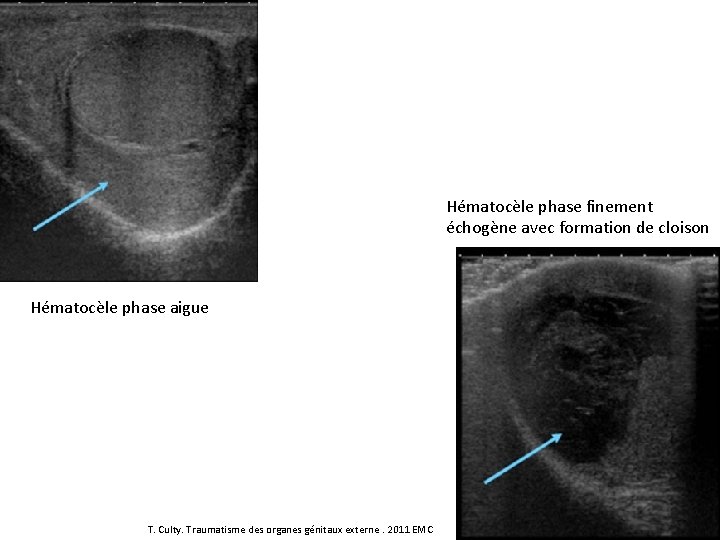 Hématocèle phase finement échogène avec formation de cloison Hématocèle phase aigue T. Culty. Traumatisme