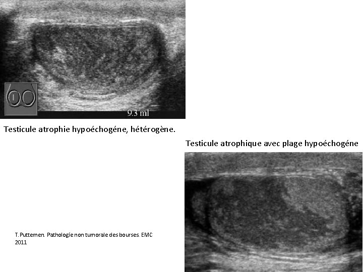 Testicule atrophie hypoéchogéne, hétérogène. Testicule atrophique avec plage hypoéchogéne T. Puttemen. Pathologie non tumorale