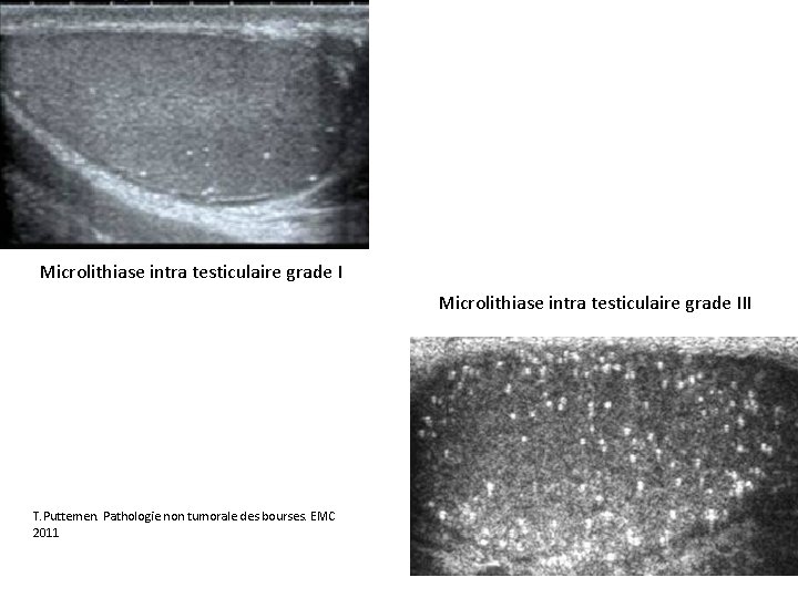 Microlithiase intra testiculaire grade III T. Puttemen. Pathologie non tumorale des bourses. EMC 2011