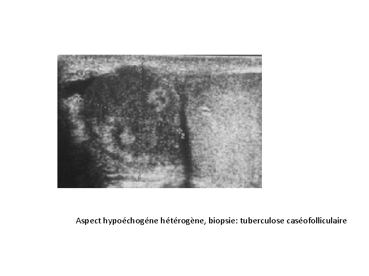 Aspect hypoéchogéne hétérogène, biopsie: tuberculose caséofolliculaire 