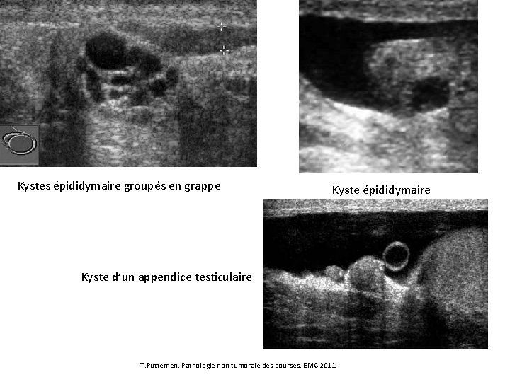 Kystes épididymaire groupés en grappe Kyste épididymaire Kyste d’un appendice testiculaire T. Puttemen. Pathologie