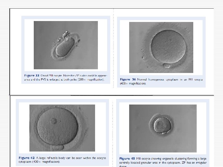 Elongated MII oocyte inside an elongated ZP. Note the PVS appears relatively normal (400×