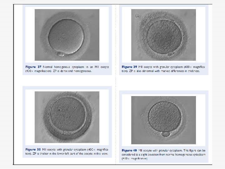 Ovoid MII oocyte. Note the ZP is also ovoid in appearance permitting the PVS