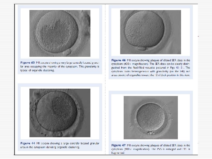 Elongated MII oocyte within a grossly distended and irregular ZP (200× magnification). 