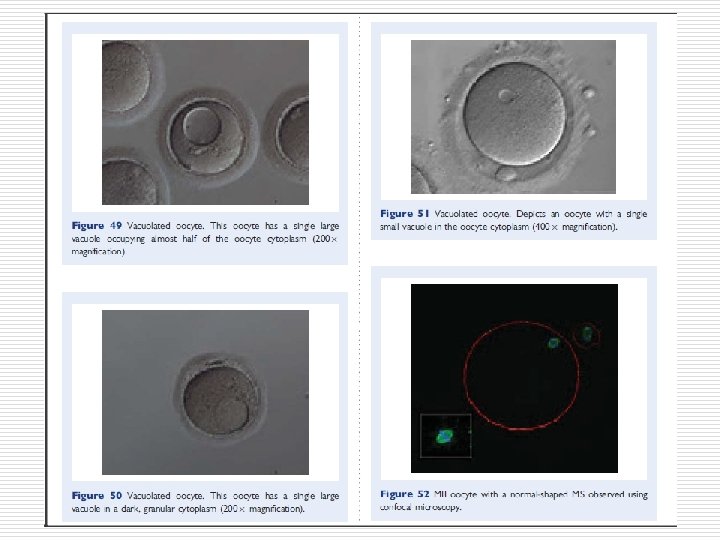 Two oocytes enclosed within a single ZP (400×magnification). 