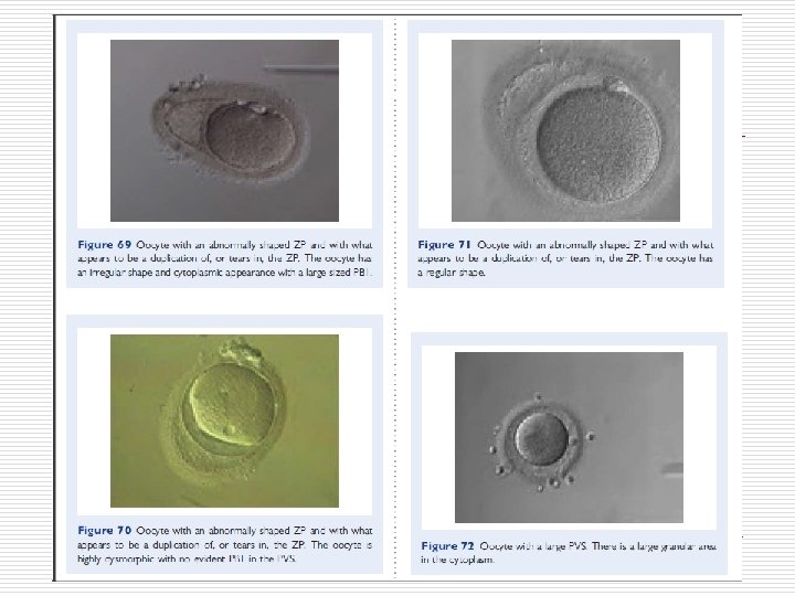 Ovoid MII oocyte. Note the ZP is also ovoid in appearance and the PVS