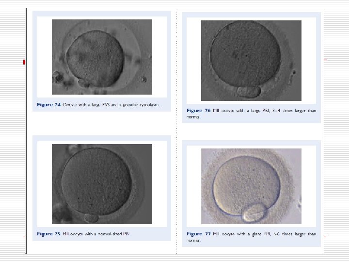 MII oocyte with granular cytoplasm (400× magnification). ZP is also abnormal with marked differences