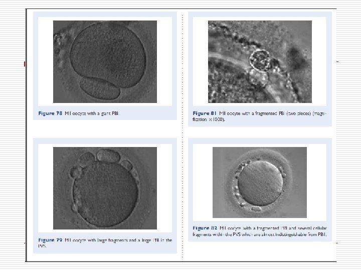MII oocyte with granular cytoplasm (400× magnification). ZP is thicker in the lower-left part