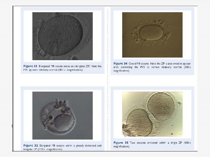 Normal homogenous cytoplasm in an MII oocyte (400× magnification). 