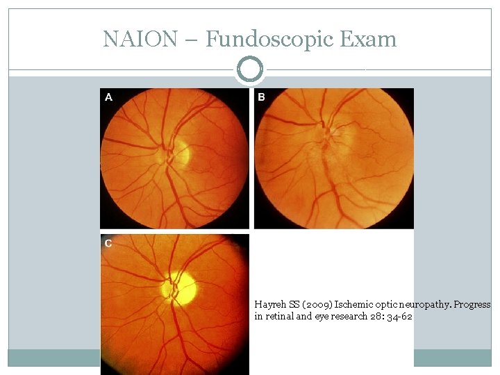 NAION – Fundoscopic Exam Hayreh SS (2009) Ischemic optic neuropathy. Progress in retinal and