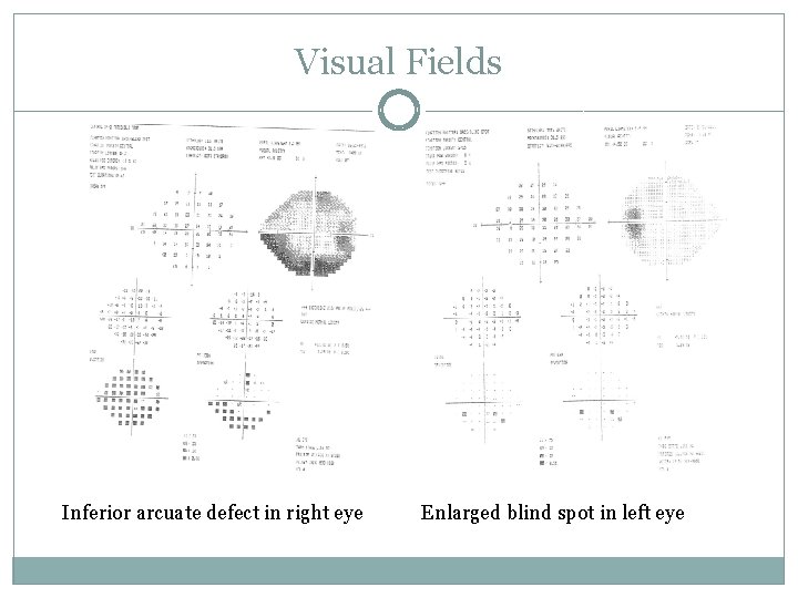 Visual Fields Inferior arcuate defect in right eye Enlarged blind spot in left eye