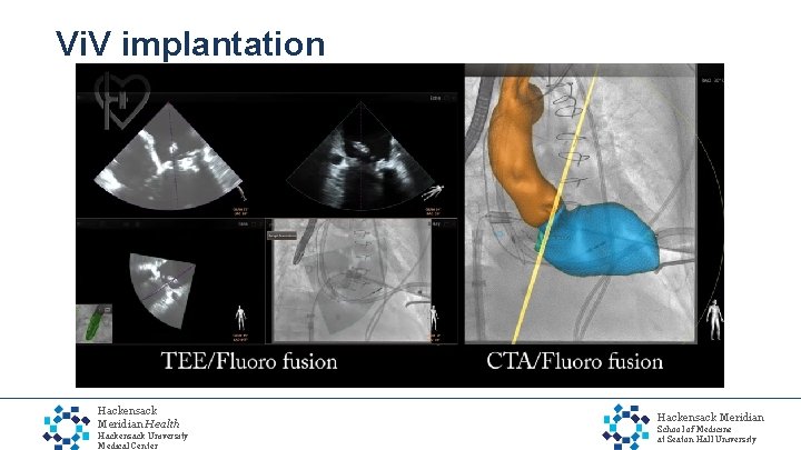 Vi. V implantation Hackensack Meridian Health Hackensack University Medical Center Hackensack Meridian School of