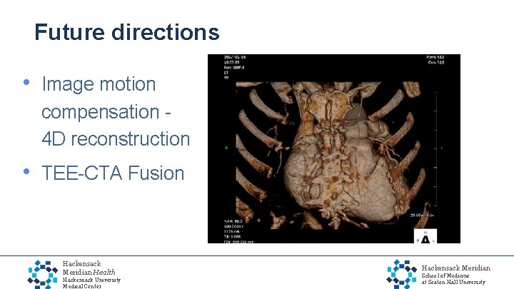 Future directions • Image motion compensation 4 D reconstruction • TEE-CTA Fusion Hackensack Meridian
