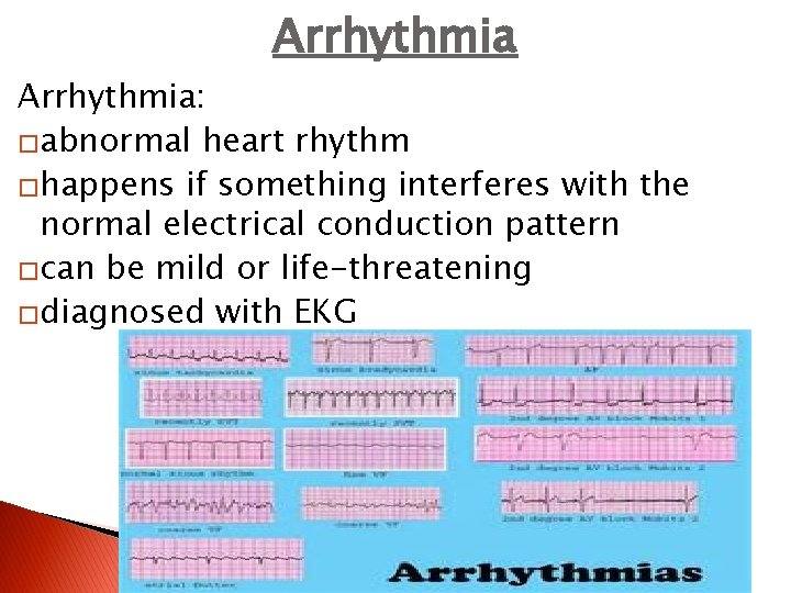 Arrhythmia: �abnormal heart rhythm �happens if something interferes with the normal electrical conduction pattern