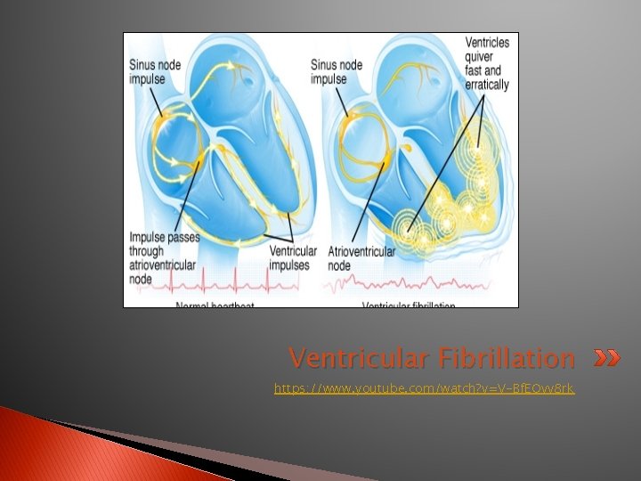 Ventricular Fibrillation https: //www. youtube. com/watch? v=V-Bf. EQvv 8 rk 