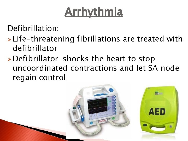 Arrhythmia Defibrillation: Ø Life-threatening fibrillations are treated with defibrillator Ø Defibrillator-shocks the heart to
