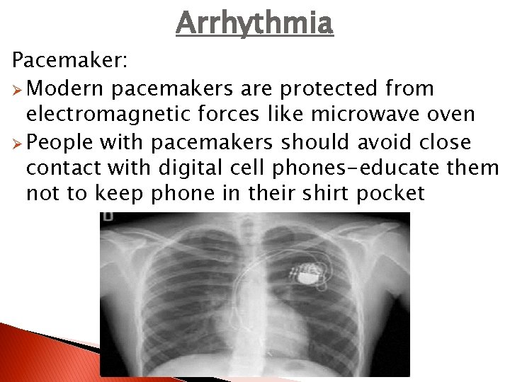 Arrhythmia Pacemaker: Ø Modern pacemakers are protected from electromagnetic forces like microwave oven Ø