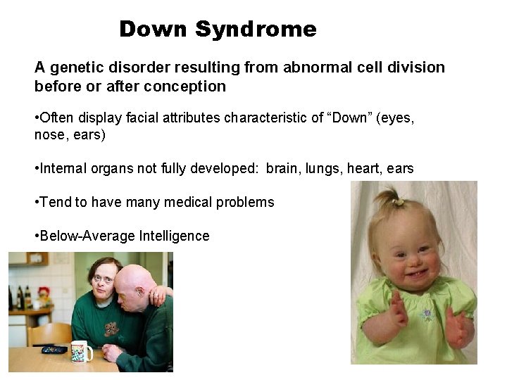 Down Syndrome A genetic disorder resulting from abnormal cell division before or after conception