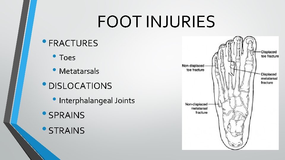 FOOT INJURIES • FRACTURES • Toes • Metatarsals • DISLOCATIONS • Interphalangeal Joints • FOOT INJURIES • FRACTURES • Toes • Metatarsals • DISLOCATIONS • Interphalangeal Joints •