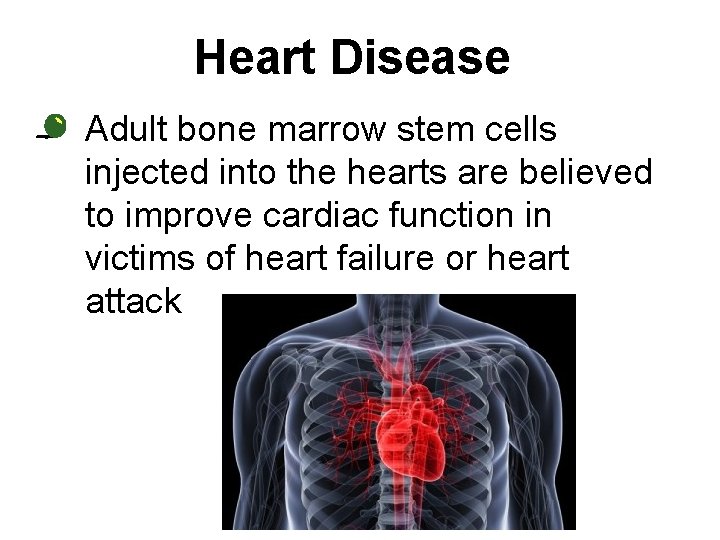 Heart Disease • Adult bone marrow stem cells injected into the hearts are believed