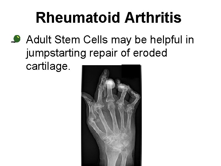 Rheumatoid Arthritis • Adult Stem Cells may be helpful in jumpstarting repair of eroded