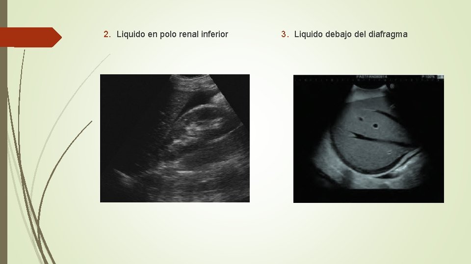 2. Liquido en polo renal inferior 3. Liquido debajo del diafragma 