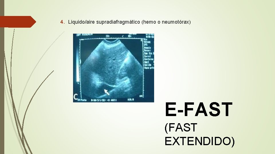 4. Liquido/aire supradiafragmático (hemo o neumotórax) E-FAST (FAST EXTENDIDO) 