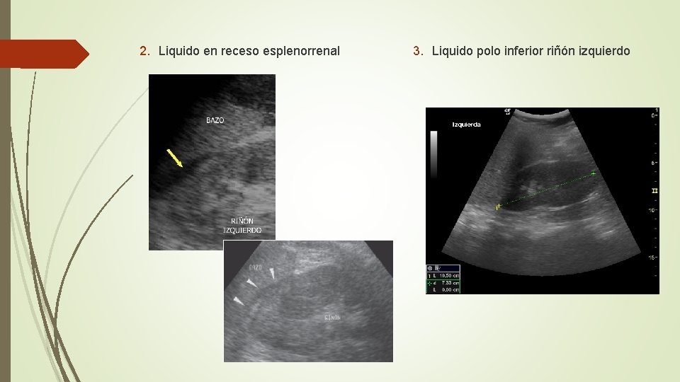 2. Liquido en receso esplenorrenal 3. Liquido polo inferior riñón izquierdo 