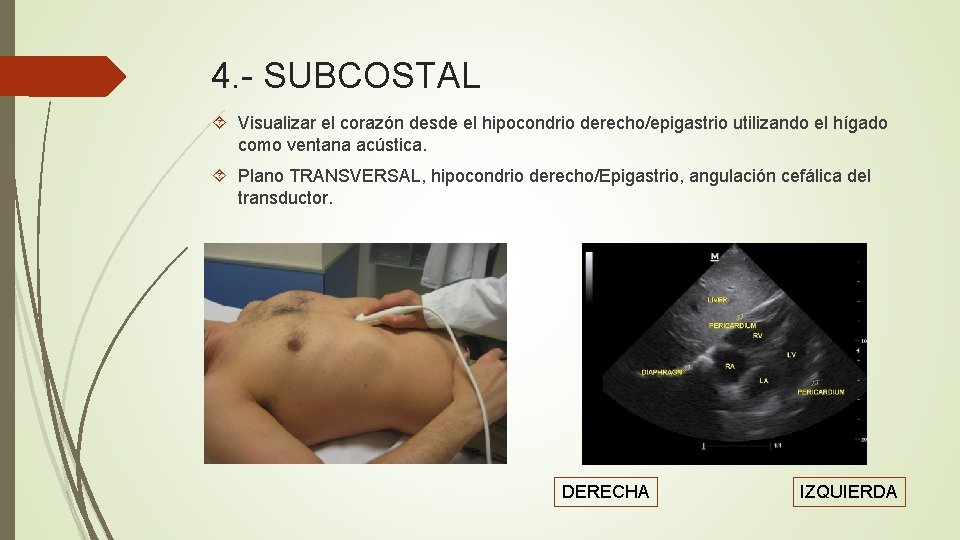 4. - SUBCOSTAL Visualizar el corazón desde el hipocondrio derecho/epigastrio utilizando el hígado como