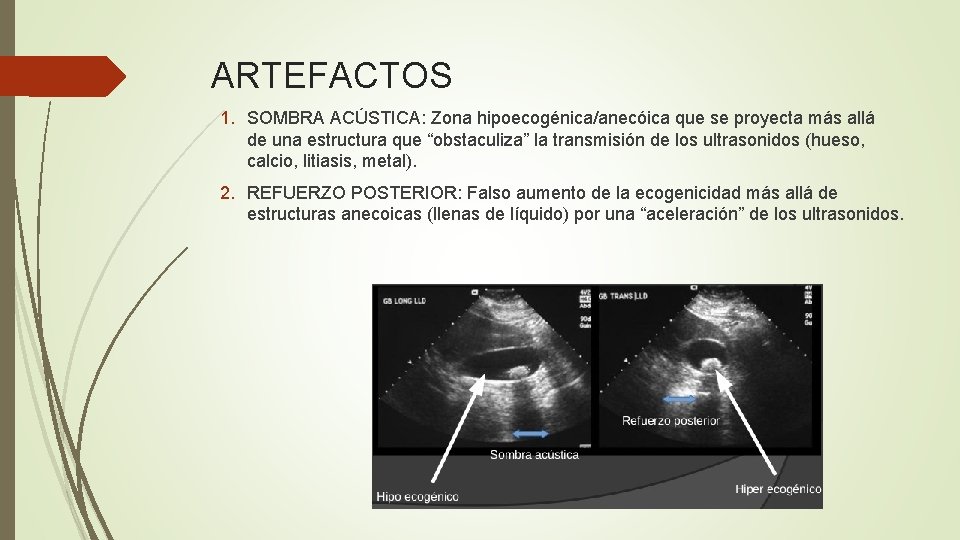 ARTEFACTOS 1. SOMBRA ACÚSTICA: Zona hipoecogénica/anecóica que se proyecta más allá de una estructura